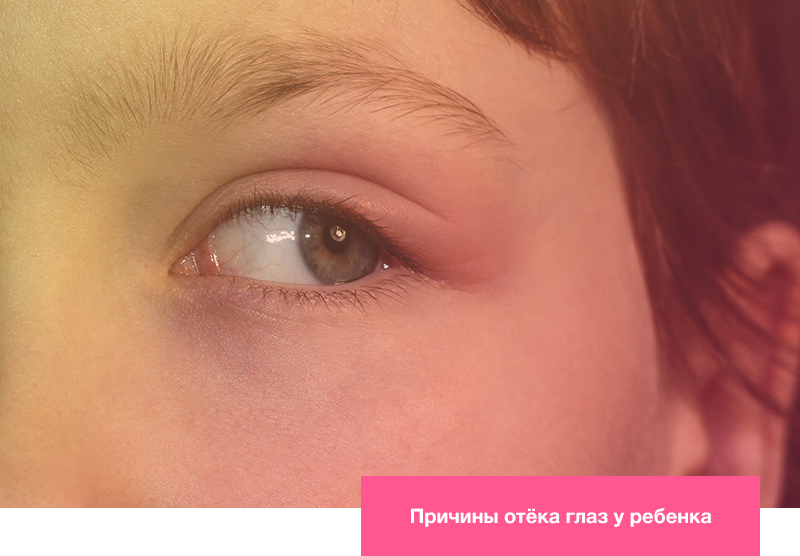 Причины отёка глаз у ребенка