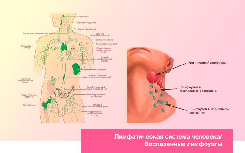Лимфатическая система человека/Воспаленные лимфоузлы